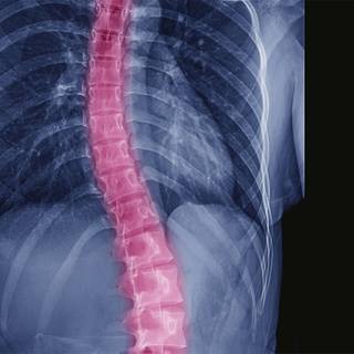 spinal-fusion-surgery-for-scoliosis-1290x1290