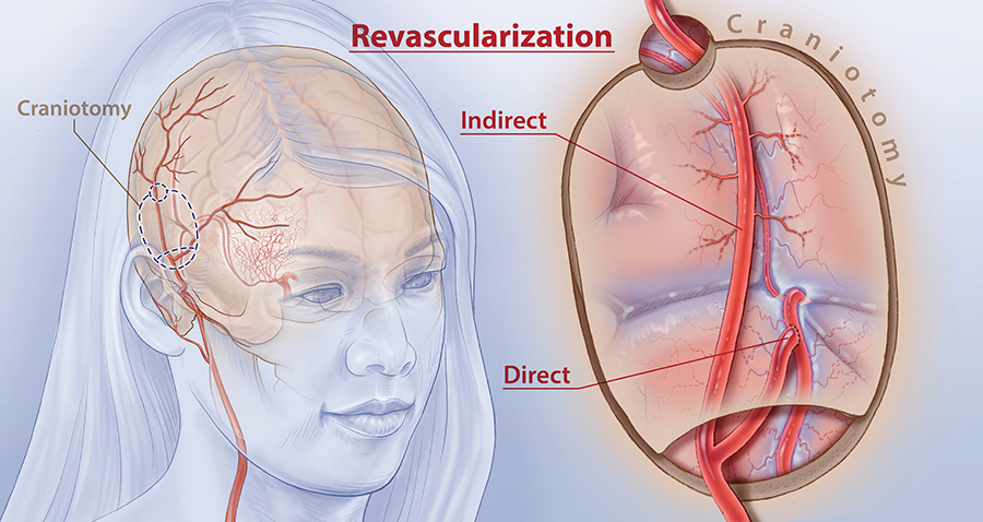 Illustration of brain surgery options for Moyamoya disease, indicating the small incision needed for a craniotomy, as well as diagrams of the two surgical options: direct revascularization, which targets the middle brain artery, and indirect revascularization, in which a blood vessel or blood-rich tissues are laid over the brain's surface. 