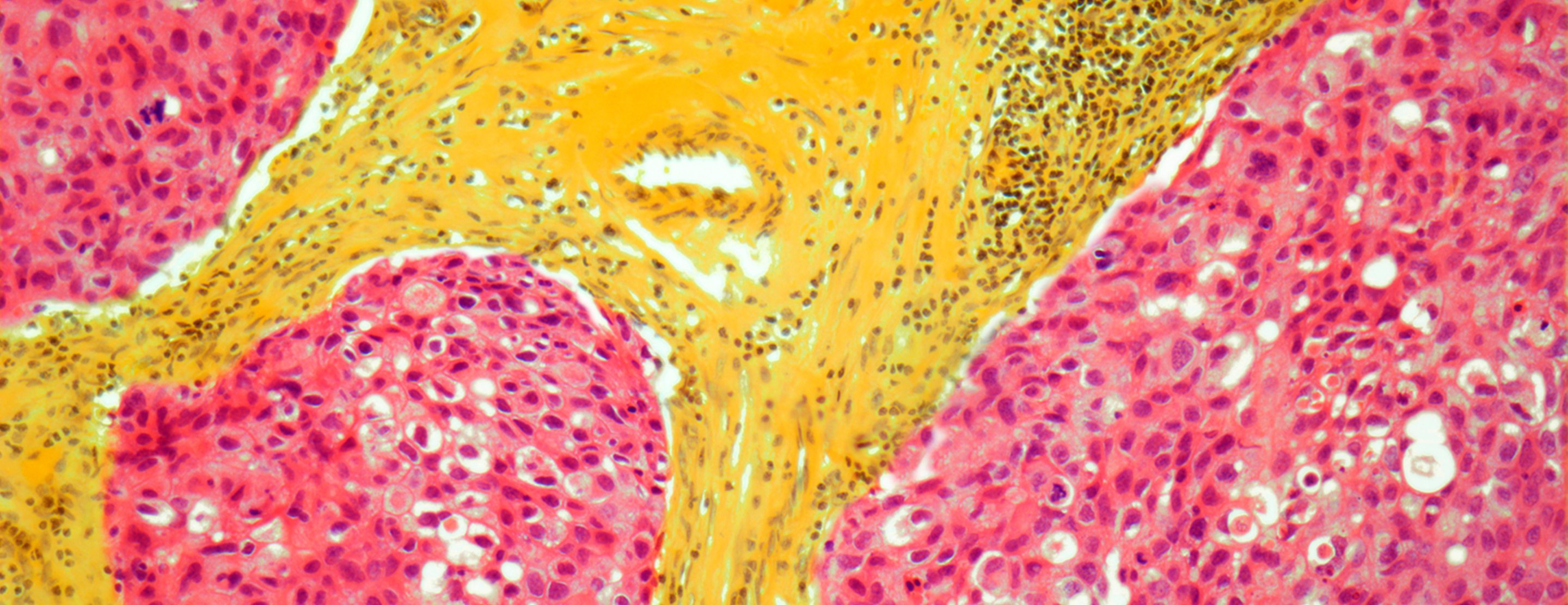 Metastatic cancer and cure, Papiloma tedavisi