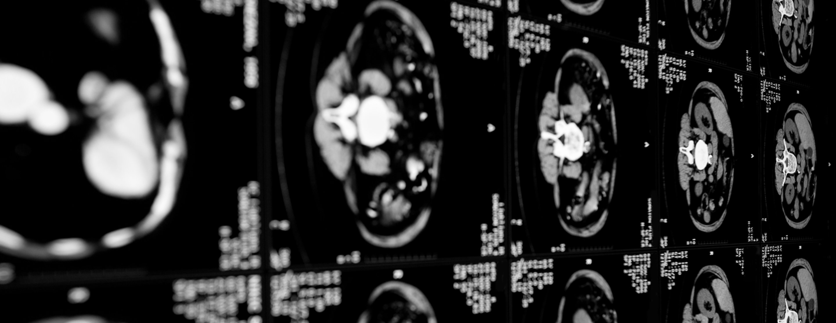 Abdominal Ct Scan