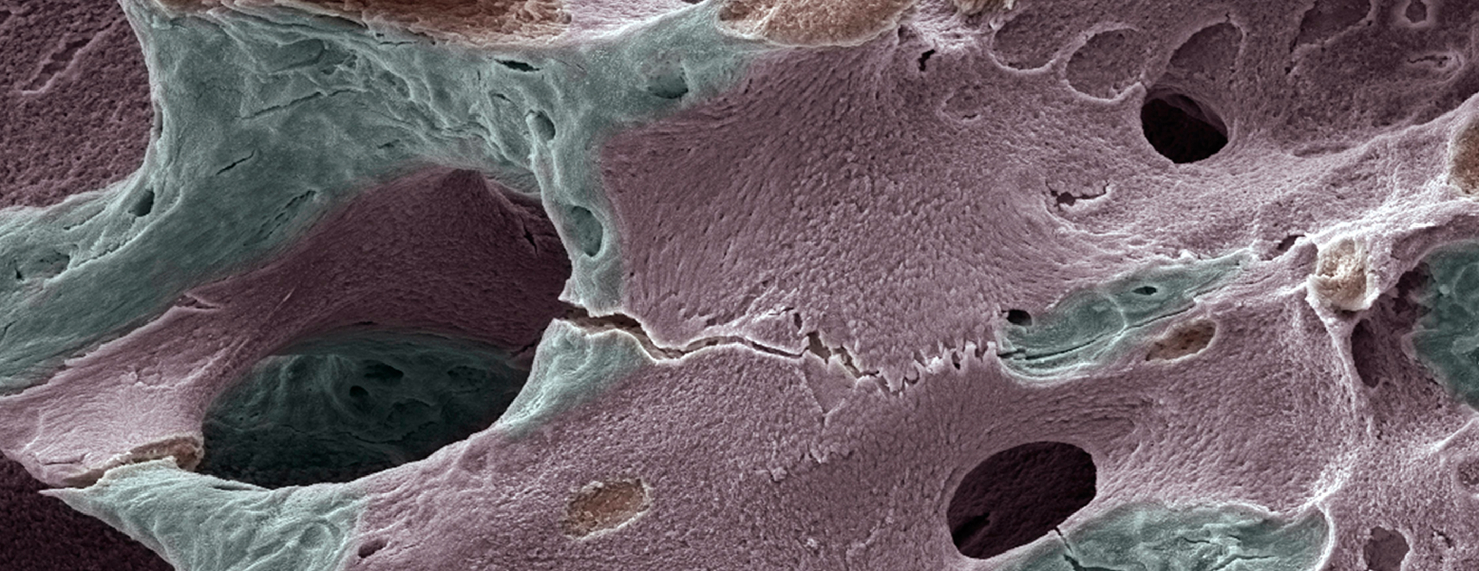 Bone Mineral Density Test
