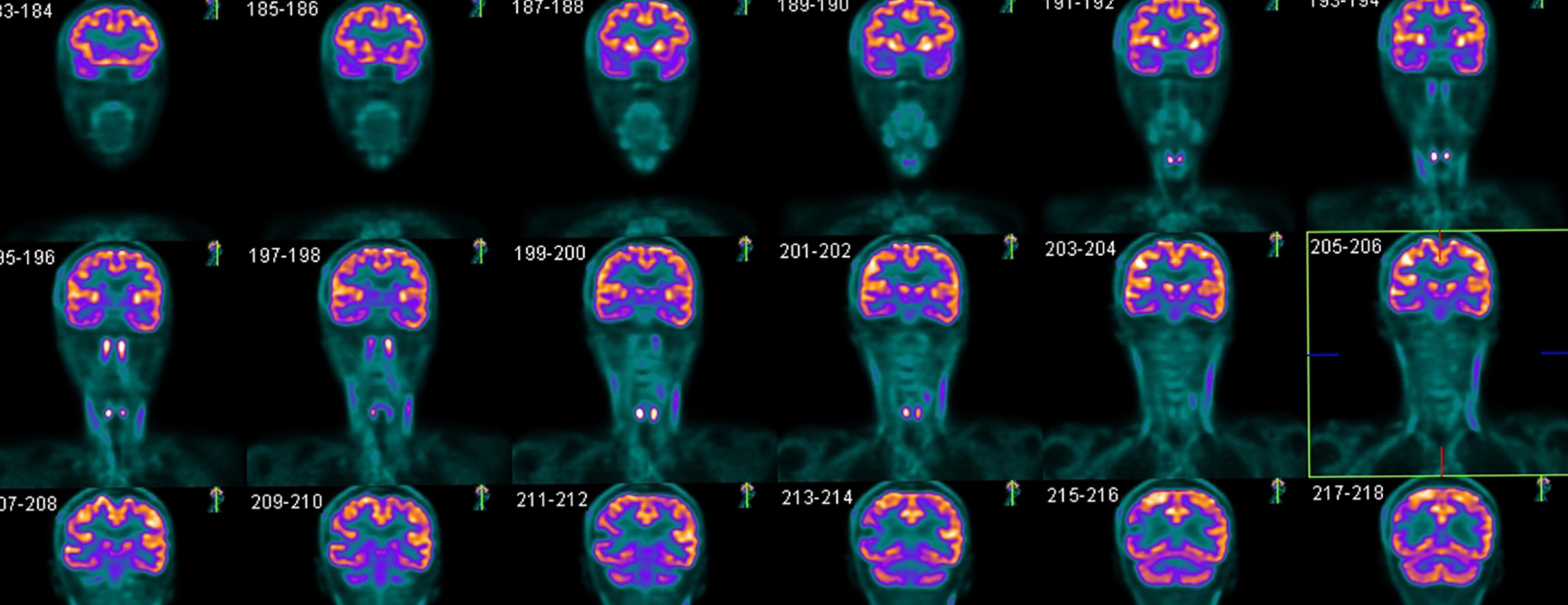 udluftning uhyre Spil Brain PET scan