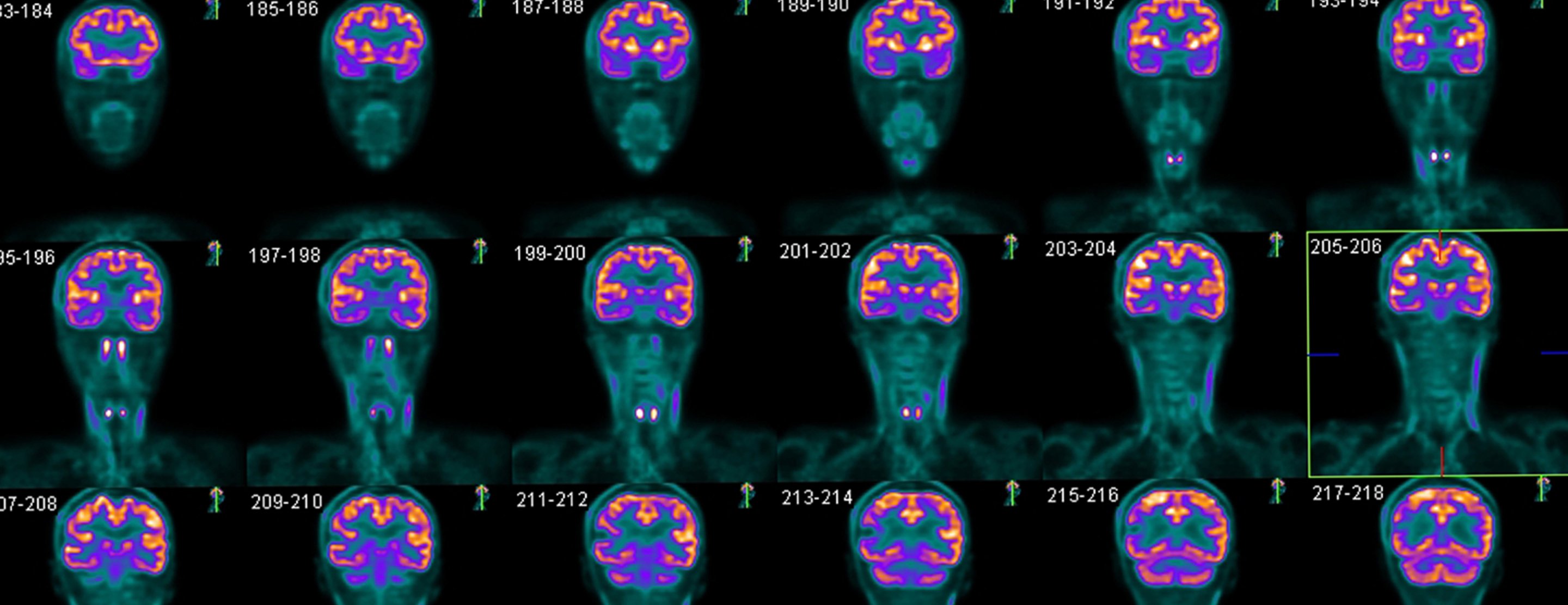 Brain PET scan