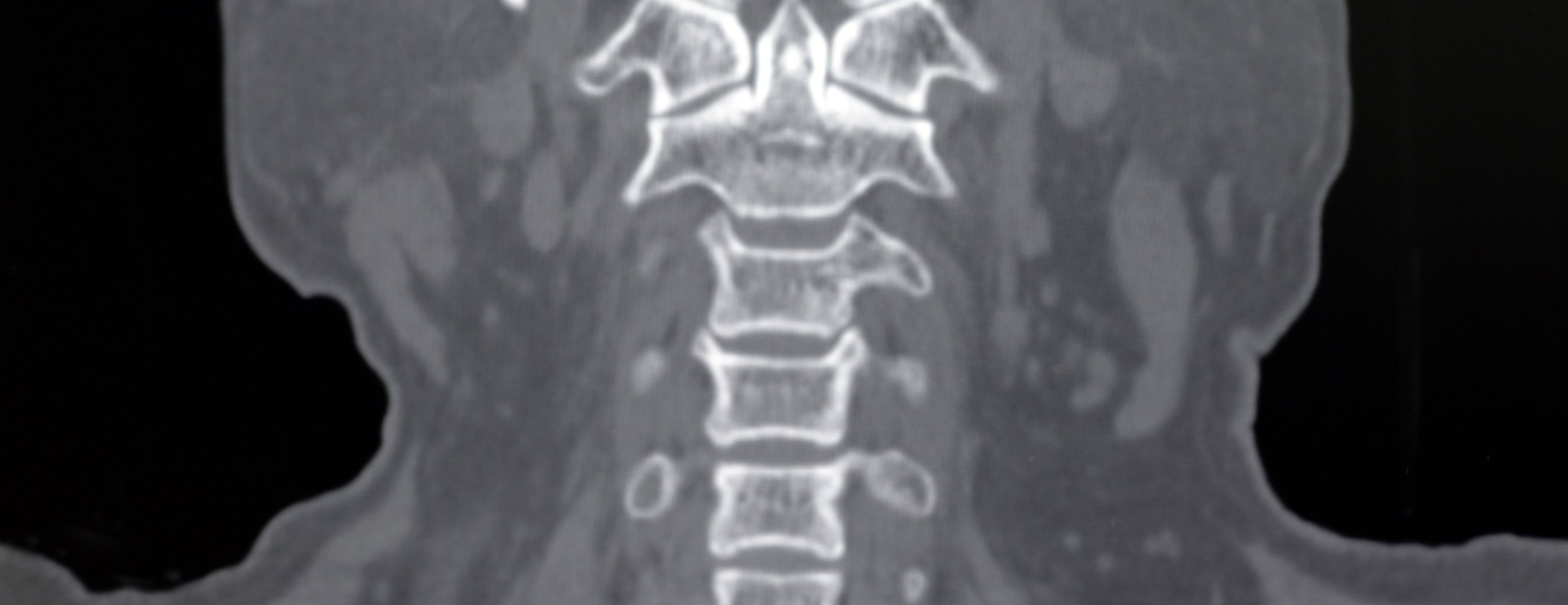 Cervical spine CT scan