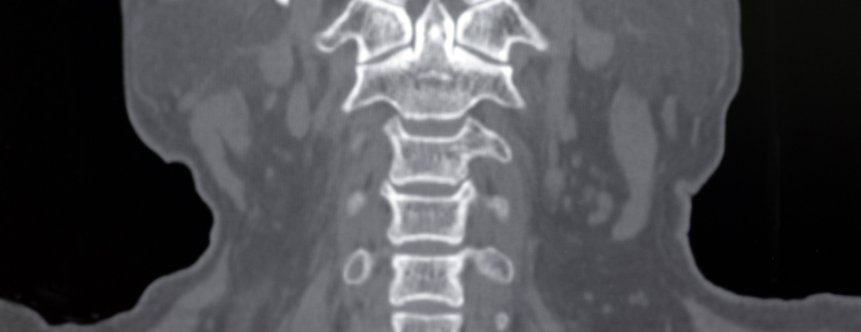 Cervical Spine Ct Scan