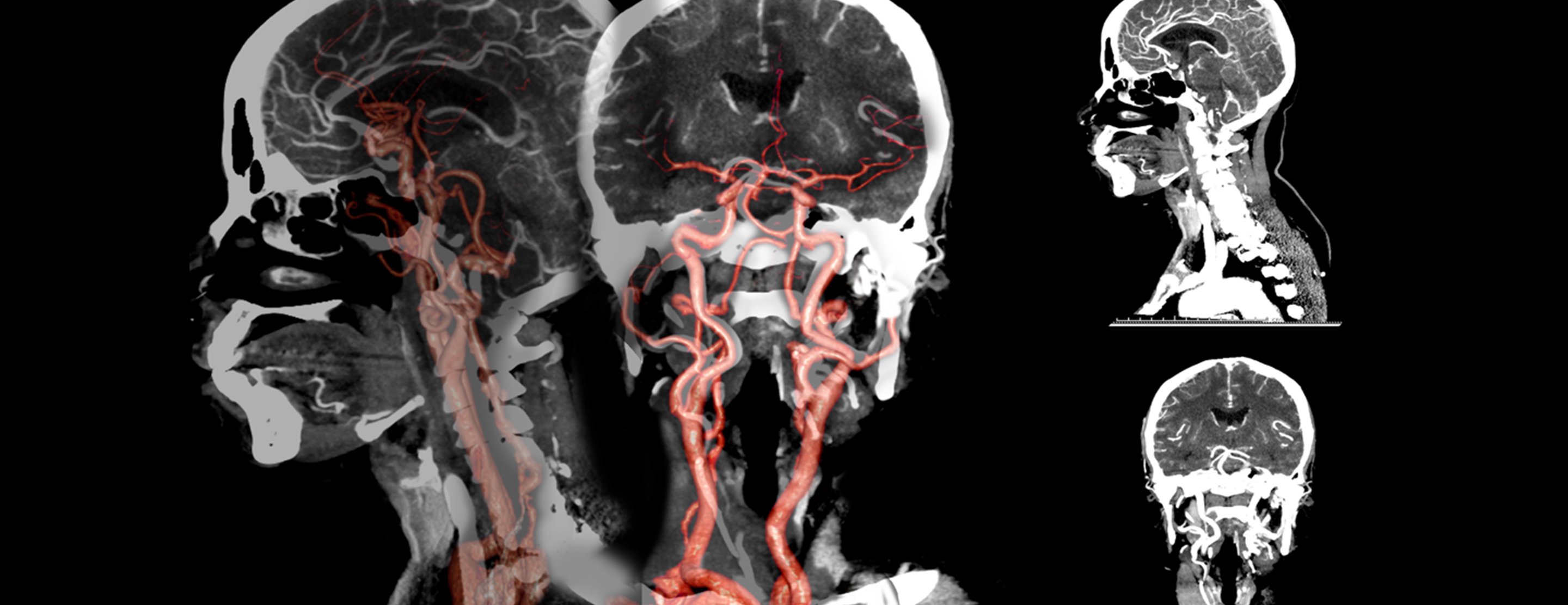 Ct Angiography Head And Neck