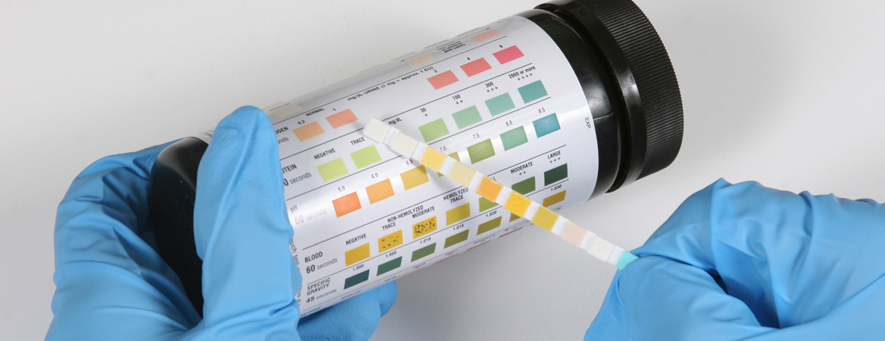 High Glucose Levels In Urine Pregnancy