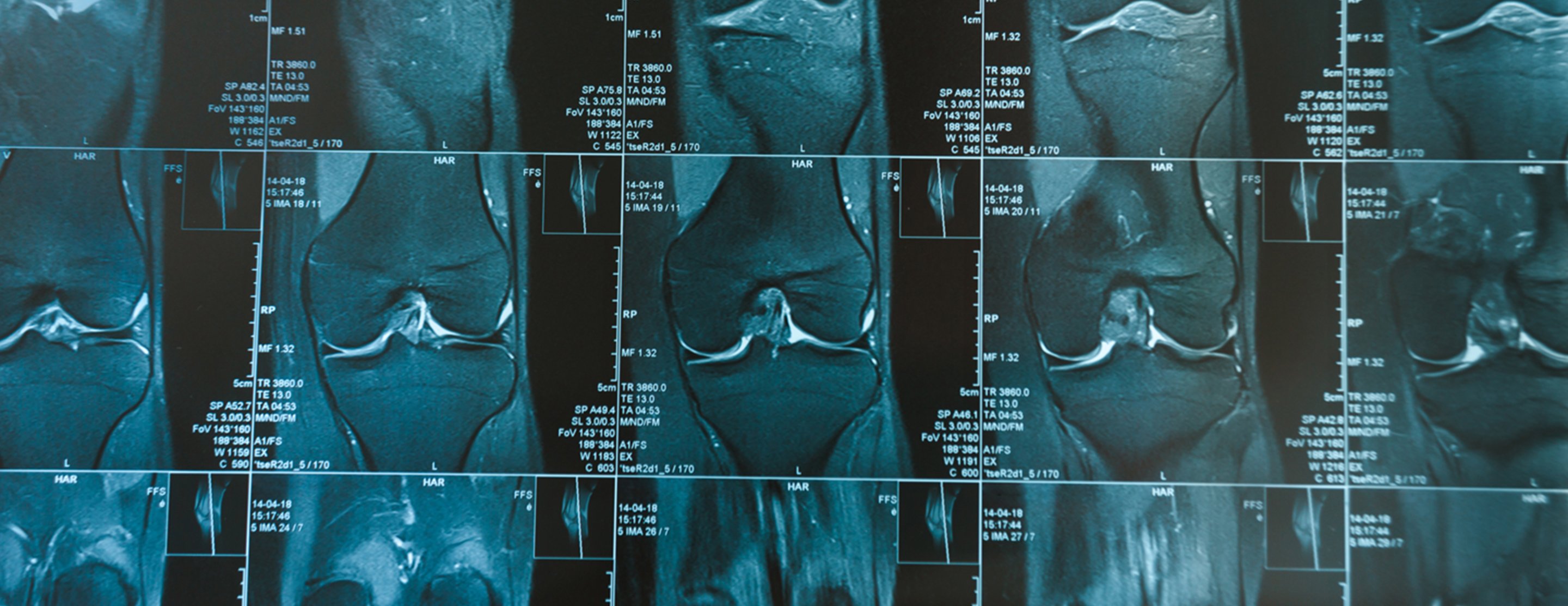 Knee MRI scan