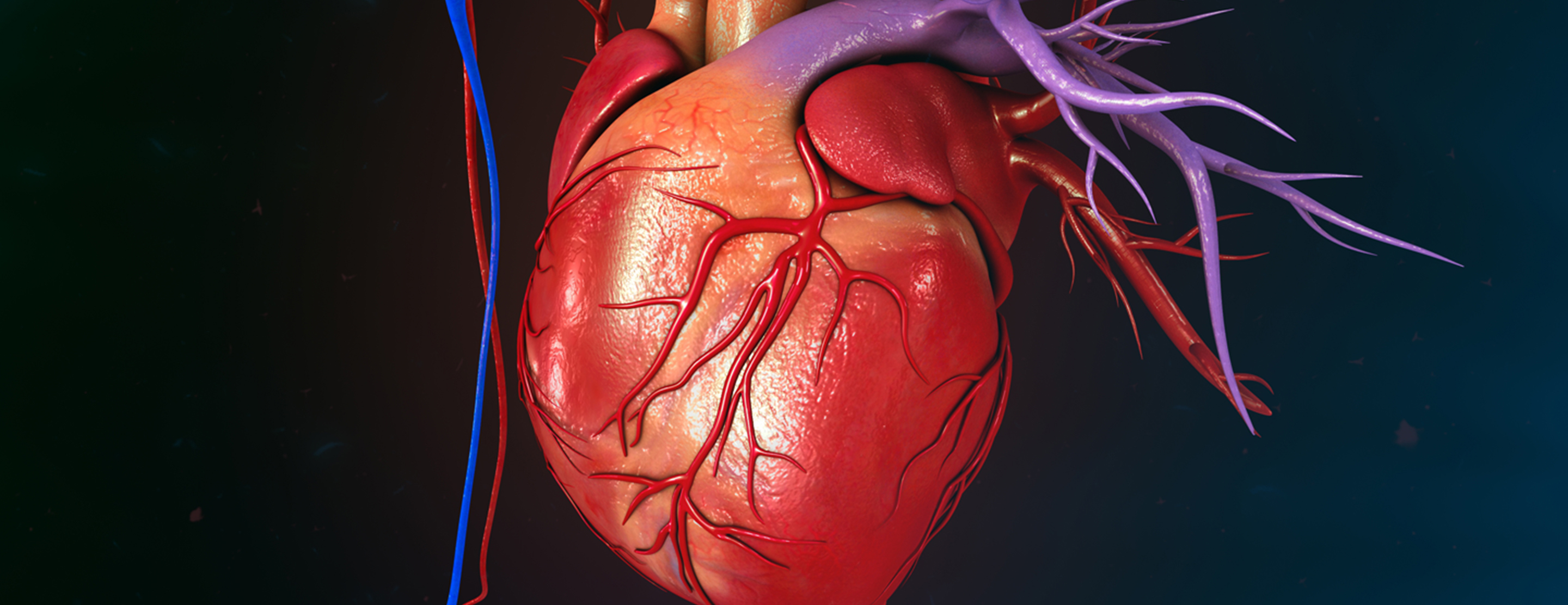 Swan Ganz Right Heart Catheterization