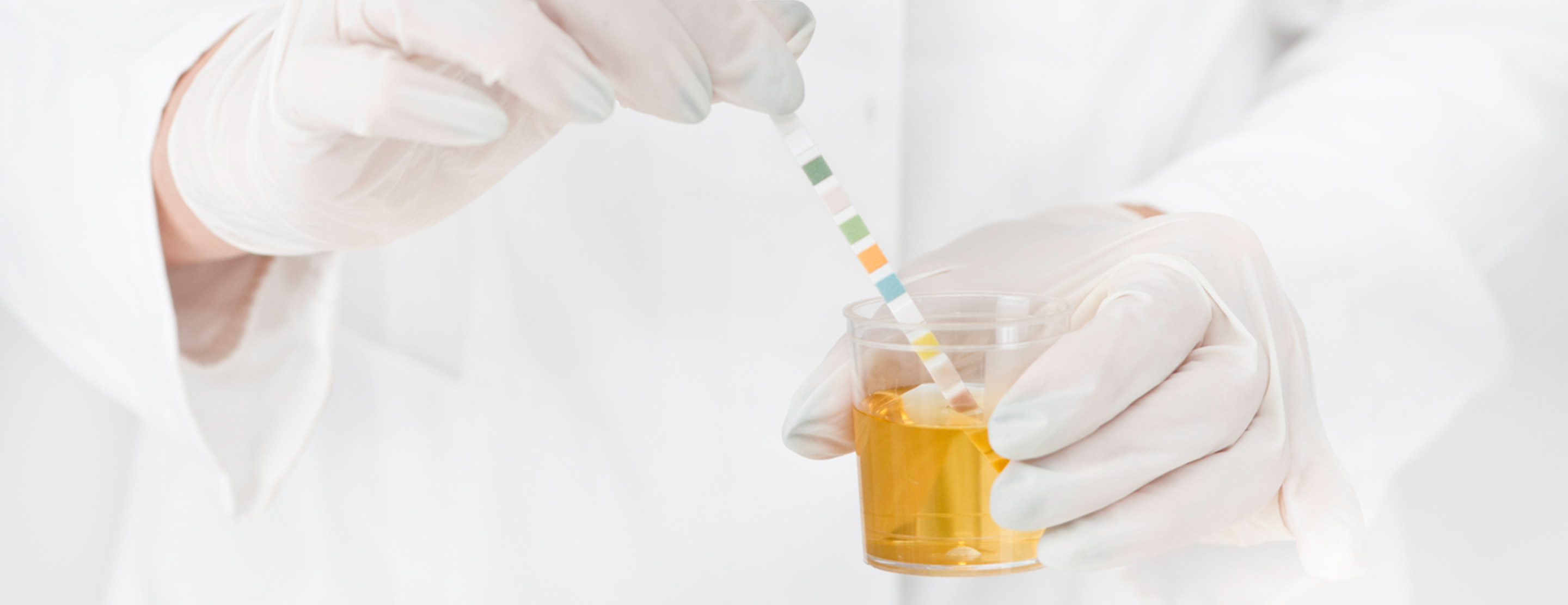 Lab technician dipping a urine dipstick into a sample to test urine pH