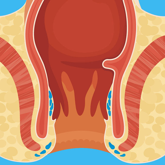 Anal Neoplasia Clinic Ucsf Health