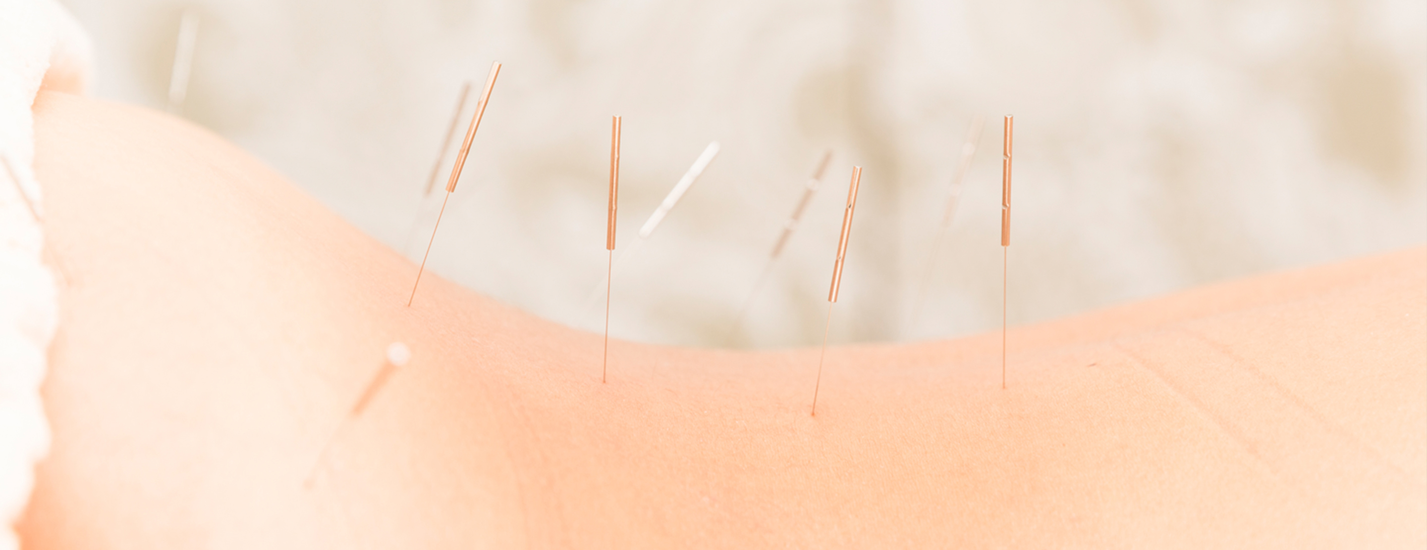 Acupuncture Encino