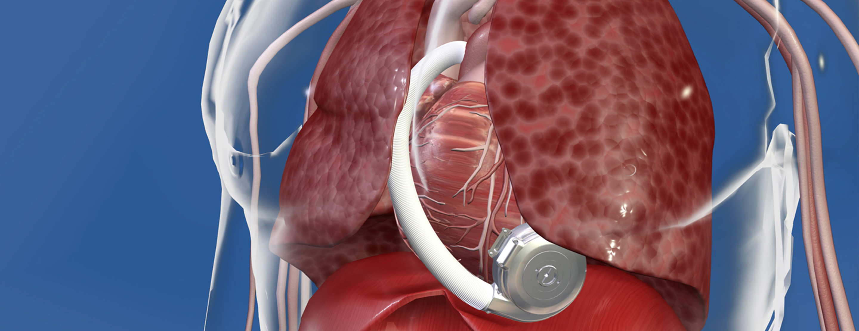 Ventricular Assist Device (VAD) | Conditions & Treatments | UCSF Health