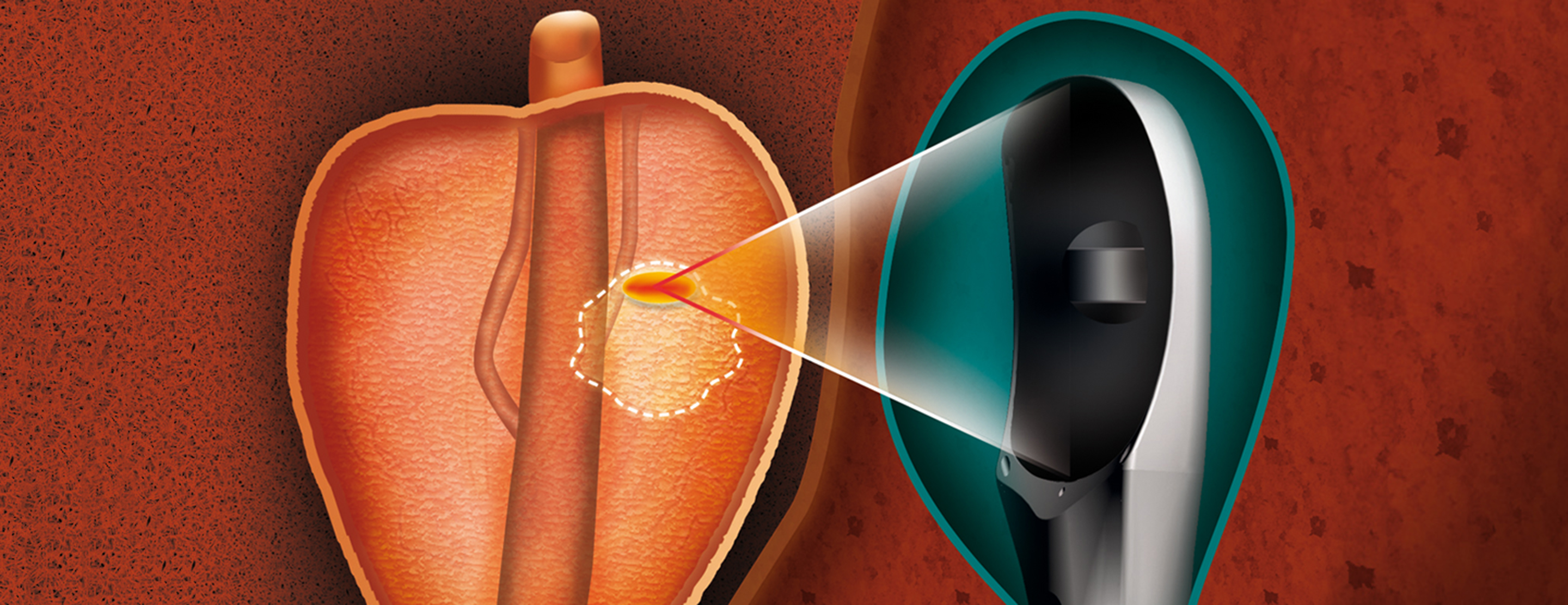 recovery after prostate hifu