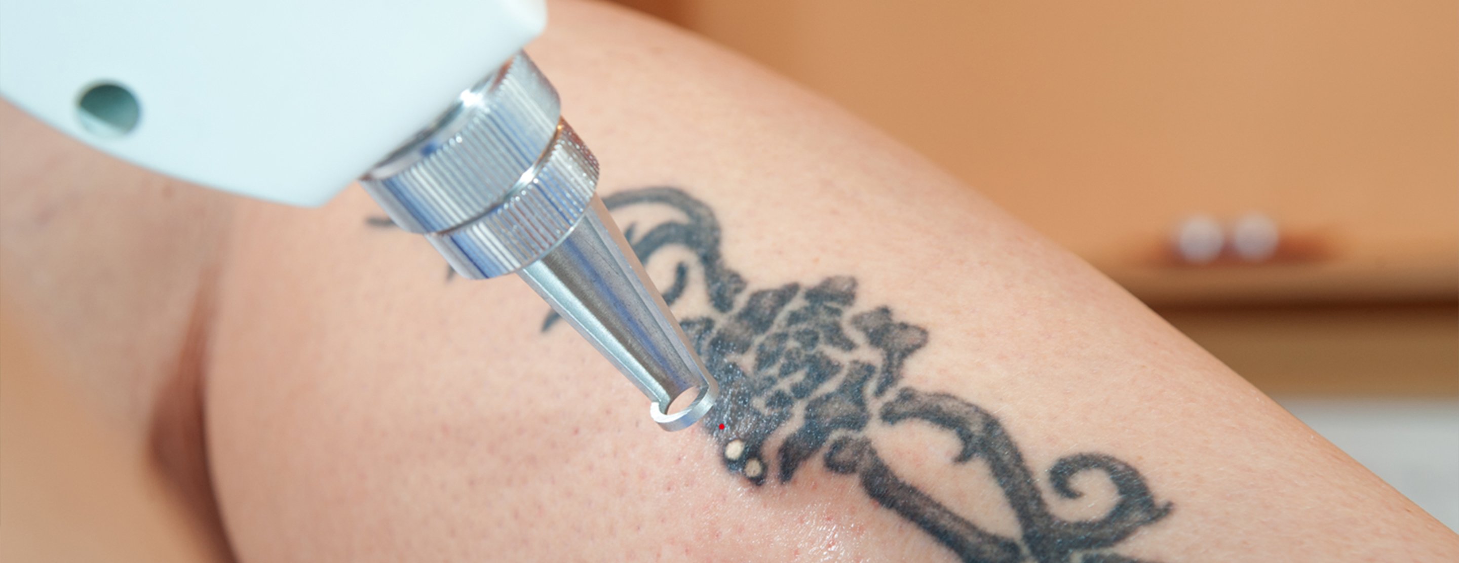 Laser Tattoo Removal: Top Reasons Why You Should Get It