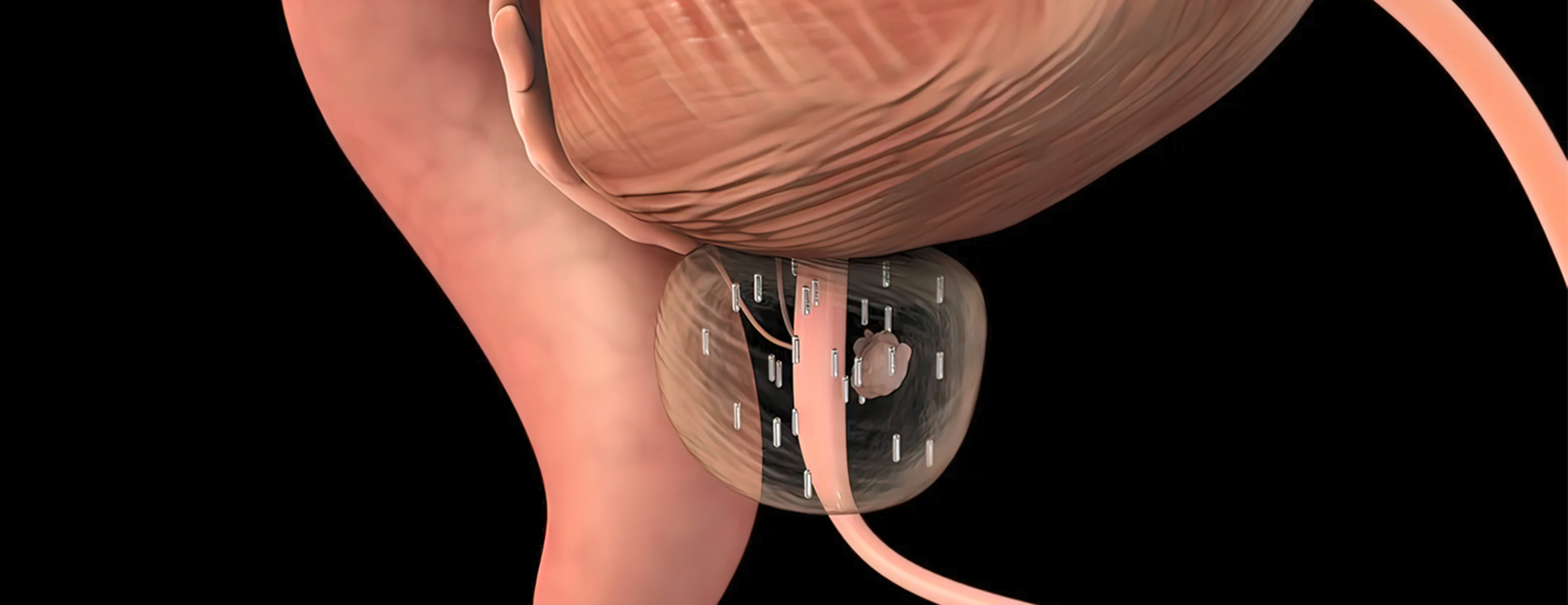 Types of Radiation Therapies for Prostate Cancer 