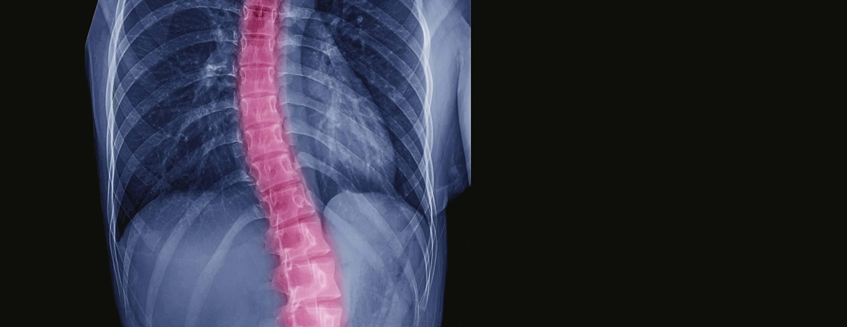 Scoliosis correction